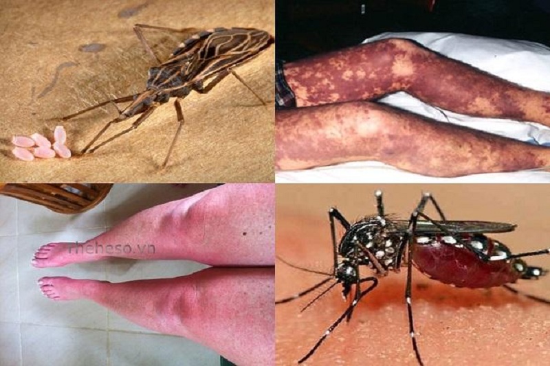 Một số ít bệnh nhân có thể sưng, viêm nơi bọ rệp đốt